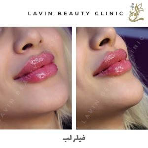 تزریق فیلر لب