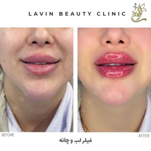تزریق فیلر لب