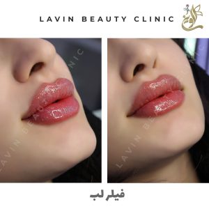 تزریق فیلر لب