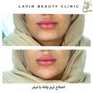 تزریق ژل لب