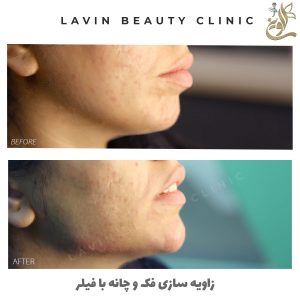 فیلر چانه و زاویه سازی فک