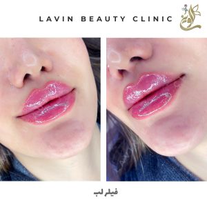 تزریق ژل لب