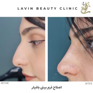 اصلاح فرم بینی