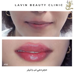 تزریق فیلر لب