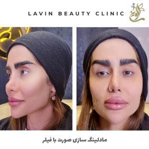مادلینگ صورت